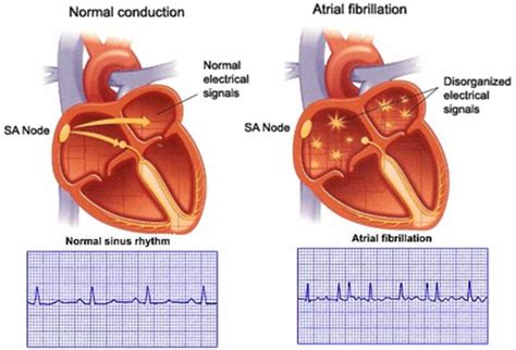 Rapid or irregular beating of the heart [ Figgerits Answers ].